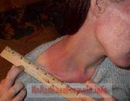 alcohol allergy red rash on neck