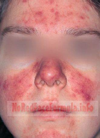 bad red face rash alcohol allergy on face