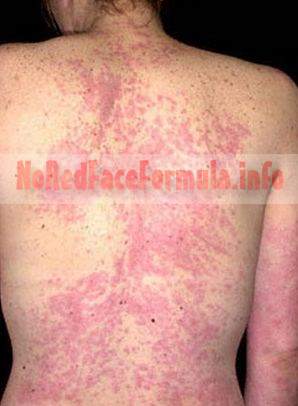 severe back rash from alcohol allergy
