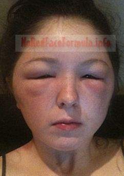 severe facial redness swelling alcohol allergy